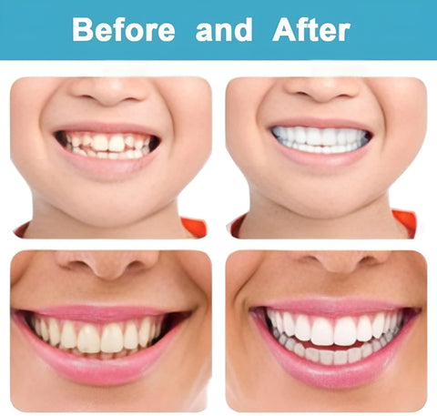🦷 Instantly Transform Your Smile – Snap-On Veneers! 😁